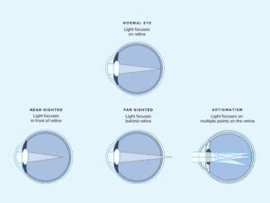 ophthalmologist eye refraction test